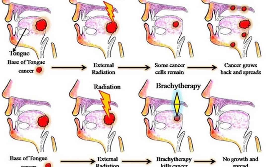 Effective Treatment of Tongue Cancer with Brachytherapy: A Complicated Procedure Mastered at Mio