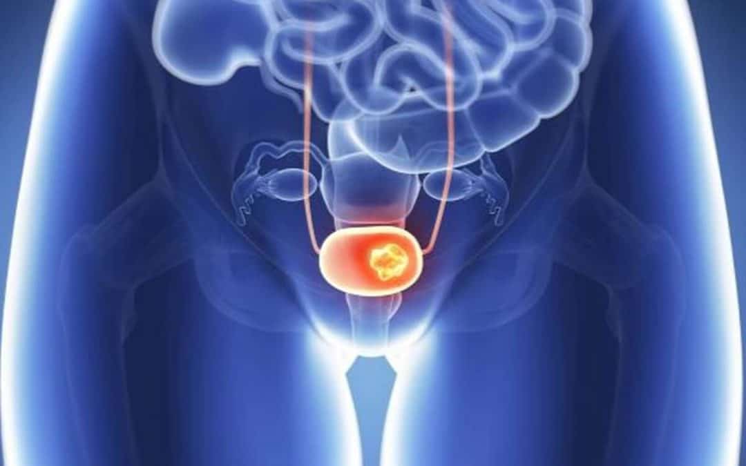 Bladder cancer on a rise in India
