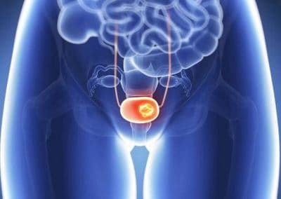 Bladder cancer on a rise in India