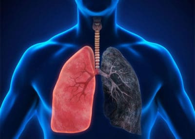 Lung cancer a lethal killer on the rise in Mangalore