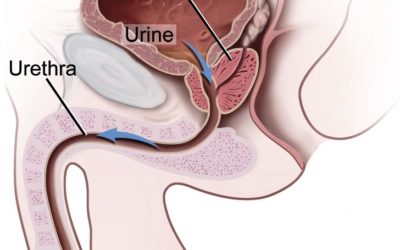 Prostate cancer rates rising in Indian men: screening is the right step in early detection