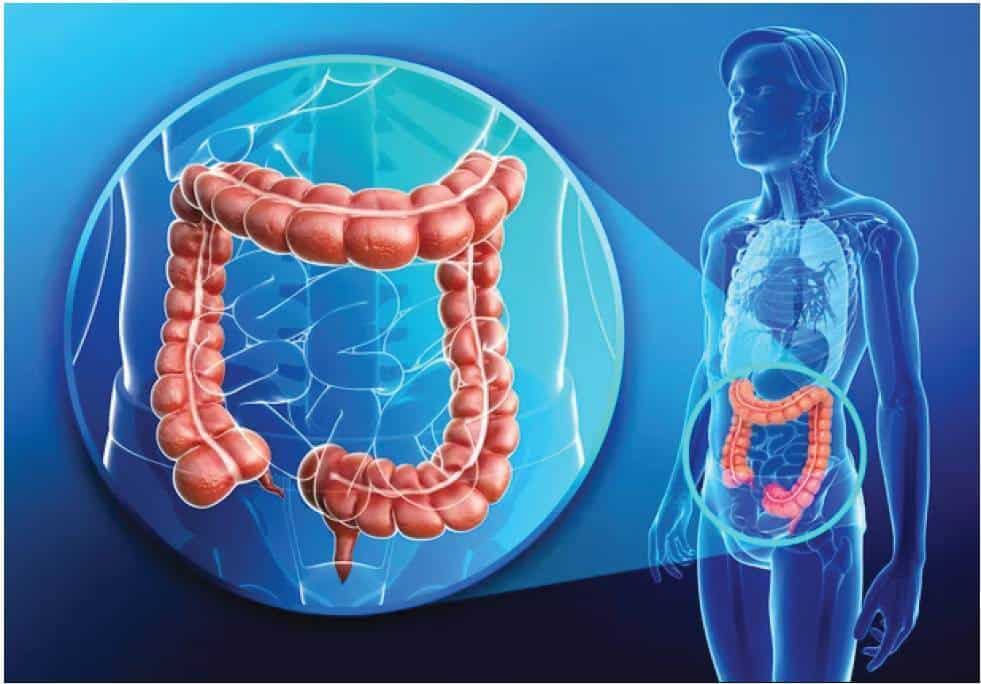 Colorectal cancers on a rise: signs and treatment