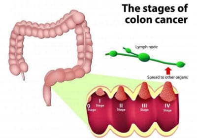 Colorectal cancers on a rise: signs and treatment